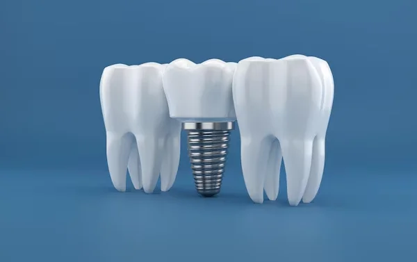 Dental Implants