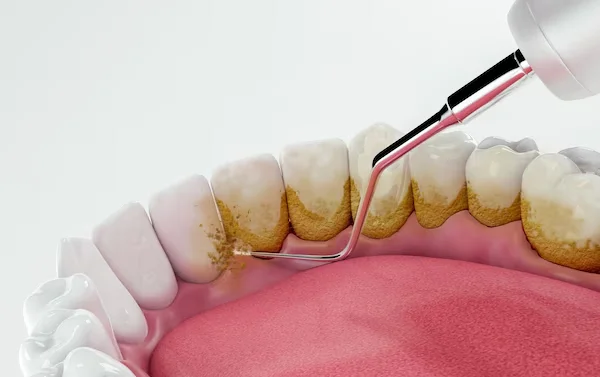Teeth Cleaning and Scaling