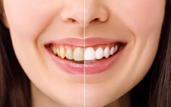 Teeth Whitening