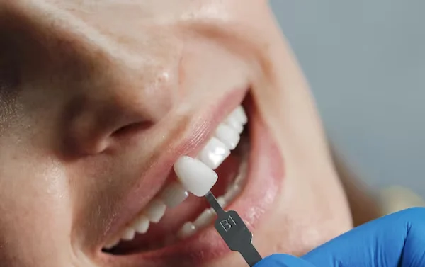 Dental Crowns  Bridges